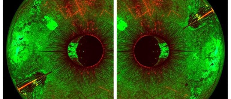 Электронные атласы изменений сетчатки при диабете: карта глазных изменений, которая меняет подход к лечению